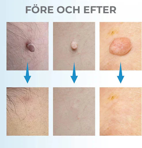 Leverfläcksborttagning - borttagning av födelsemärke